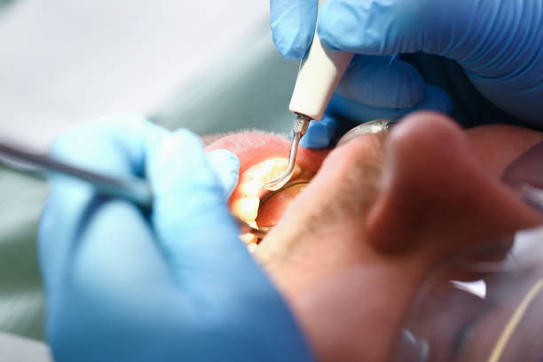 Best Broken or Chipped Tooth Repair in Five Corners, WA