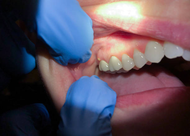 Best Knocked-Out Tooth (Avulsed Tooth) Treatment in Five Corners, WA